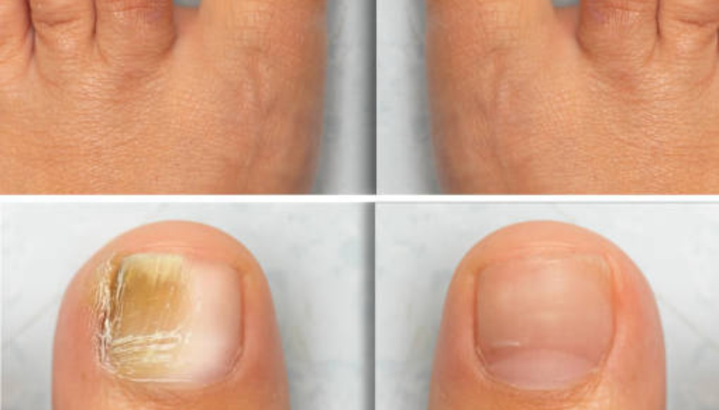 How Exercise Affects Foot Health